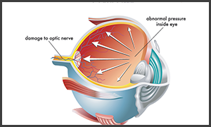 Hurst Glaucoma