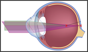 Astigmatism in 76054