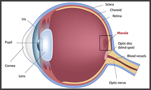 Hurst Macular Degeneration