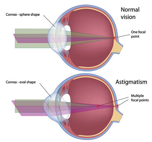 Astigmatism Hurst 
