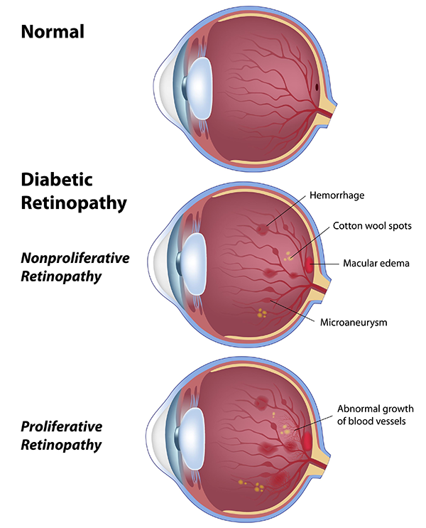 Diabetic Retinopathy in 76054